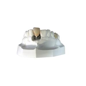 Wholesale Custom Dental Implant Locators High Stability Bar Attachment Denture from china suppliers