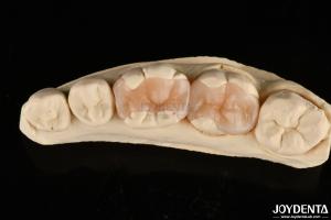 Wholesale Natural Polymerized Porcelain Dental Inlay Onlay For Tooth Restoration from china suppliers