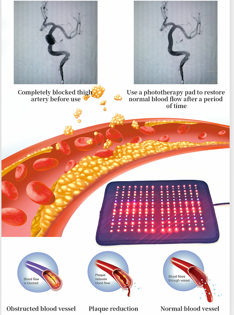 810nm IR70 Customized Infrared Light Therapy Pads For Medical Photodynamic Machine