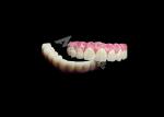 Zirconia Dental Implant Crown Bridge All On 6 For Missing Teeth Replacement