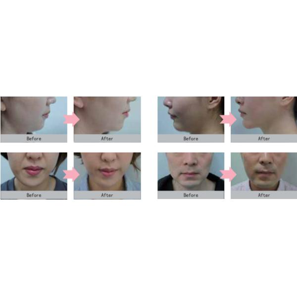 Stable Working Portable Hifu Machine , Home Hifu Machine No Side Effects