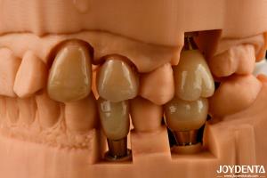 Wholesale Customizable Implant Crown and Bridge Achieve a Natural Look with Long-lasting Results from china suppliers