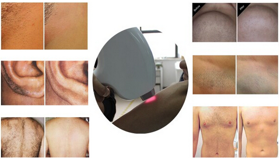 laser hair removal product.jpg