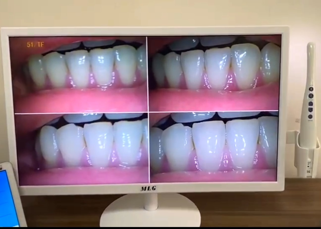 5G Wireless Wifi Dental Intraoral Camera 19 Inch Dental Implant LCD Monitor