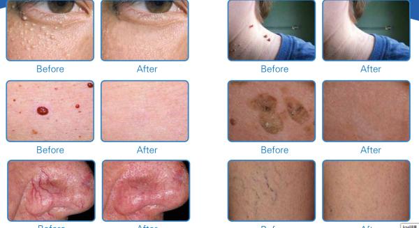 Painfree vein treatment machine with Truly 30MHZ