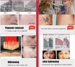 beijing sunrise new portable picosecond laser