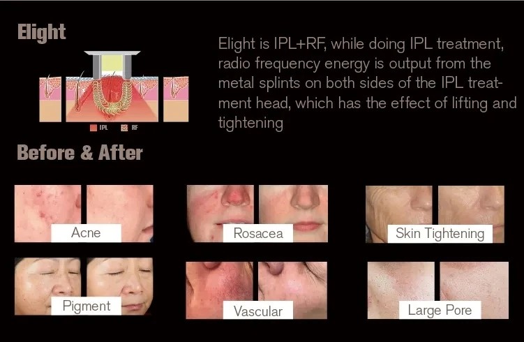 Professional Permanent IPL OPT Epilator Skin Rejuvenation Hair Removal Machine
