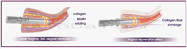 RF CO2 Fractional Skin Rejuvenation and Vaginal Tightening Laser Machine