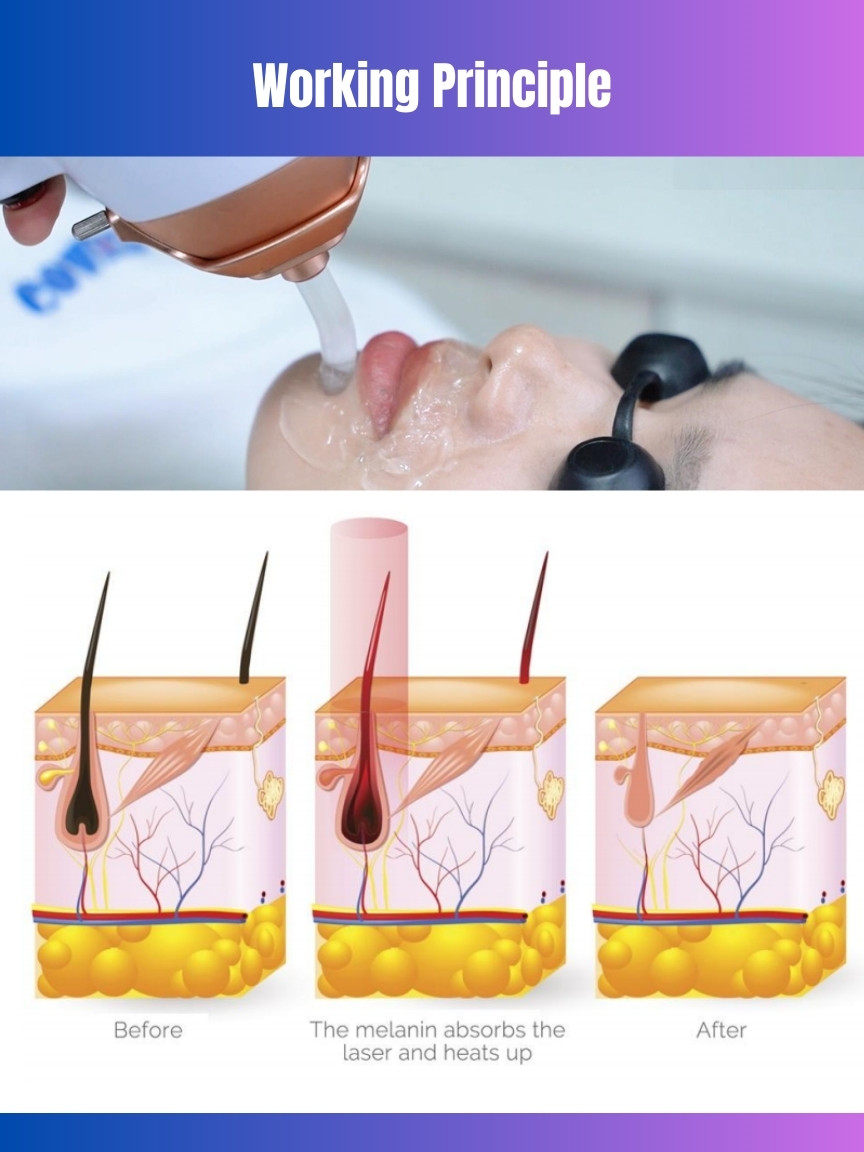 755 808 1064nm OEM Diode Laser Hair Removal Device for Ozero Khanka Pioneer