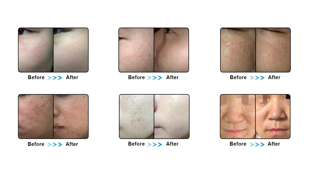 DPL elight IPL HR permanent hair removal acne photorejuvenation facial multifunctional beauty machine