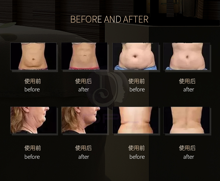 newest radio frequency skin tightening machine with 80k cavitation system
