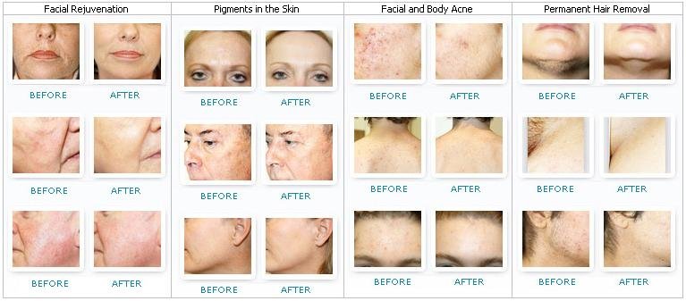 Best LFSS 3 in 1 skin beauty machine elight nd yag laser ipl rf