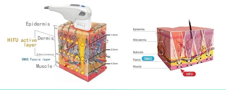 Professional 3D hifu device 11 lines for wrinkle remover