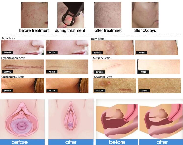 Carbon Dioxide Laser Fractional CO2 Machine For Skin Brightening And Tightening