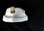 Custom Dental Implant Locators High Stability Bar Attachment Denture