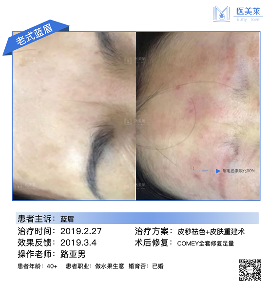 1064nm 2-10mm continuously adjustable  Spot  Pigmentation eraser Removal  Picosecond Laser Machine 10