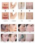 Medical Q Switched Nd Yag Laser Machine , Beauty Laser Tattoo Removal Machine