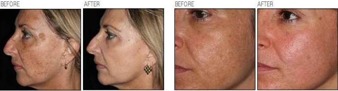pigmentation removal  scar removal