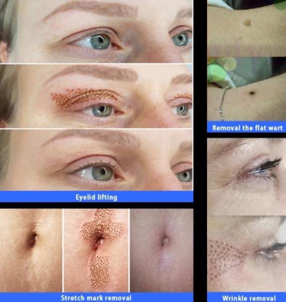 100%Korea Fibroblast plasma pen jet plasmalift Face Eyelid Lift plamere premium
