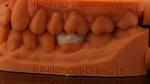 Strength Emax Ceramic Crown Dental Onlay with Excellent Stain Resistance China