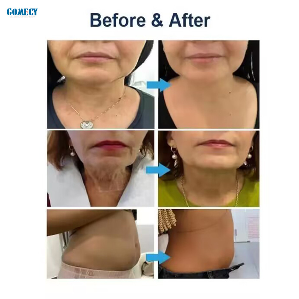 2024 New Arrivals Hifu Technology Hifu Face Mopheus 8 Hifu Vmax Machine Ice Hammer Focused Ultrasound Body Slimming