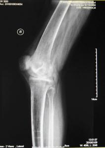 Wholesale KND-A Low Fog Medical Dry Imaging Film For X Ray Examination On AGFA 5300, 5302, 5500 from china suppliers