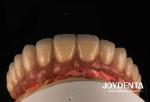 Casting And Milling PFM Tooth Crown , Dental Restorations Porcelain Fused Metal