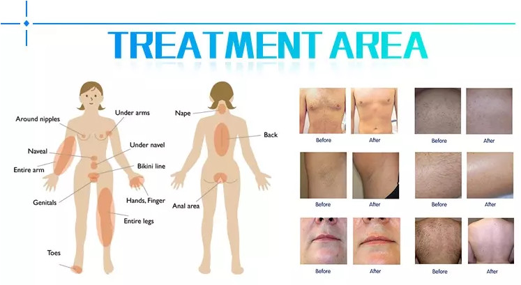 diode hair removal laser 808nm diode laser hair removal machine
