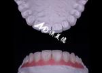Translucency EMAX Porcelain Veneer Resistant to Stains / Strength
