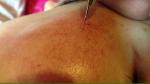 Effective 30Mhz painfree RBS spider veins removal machine for vascular removal