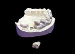 Dental Implant with Ceramic Crown and titanium Abutment for molar