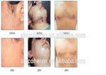 Professional IPL Skin Rejuvenation Machine , Intense Pulsed Light Hair Removal