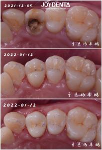 Wholesale Accurate Fit Dental Porcelain Inlay Damaged Teeth Restoration For Adults And Children from china suppliers