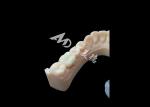 High Strength Ceramic Zirconia Posterior Dental Crown Superior Aesthetic and