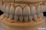 0.3mm Thickness Ips Emax Veneers Ceramic Veneers Anterior Posterior Restorations