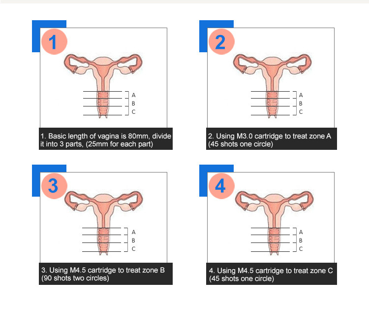 Feminine Home Hifu Machine Portable for Vaginal Rejuvenation Treatment