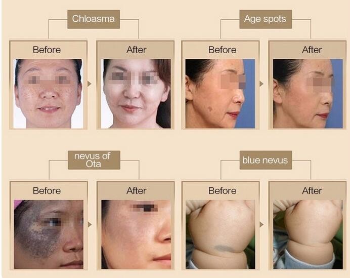 peeling 755 1064 532 picosecond laser