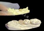 IPS e.max Ceramic Inlays and Onlays for Natural Looking Dental Restoration