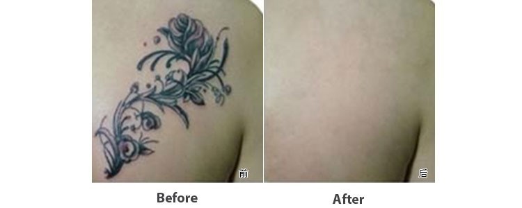 High Power Portable Picosecond Laser Tattoo Removal Machine One Pieces Handle
