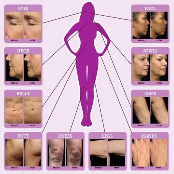 Fractional RF microneedle for skin rejuvenation acne removal collagen regenerati