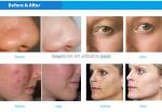 Hydro Facial Q Switch Nd Yag Laser Tattoo Removal Machine Ultrasonic Dermabrasio