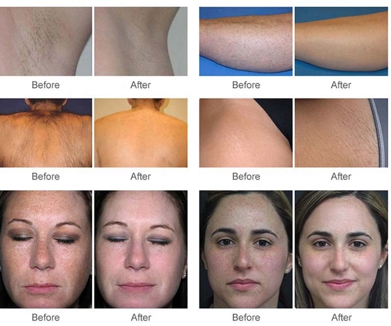 Hair Removal Laser Beauty Equipment 808nm Diode Painless Skin Rejuvenation