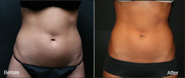 Liposonix Fat Reduction Hifu High Intensity Focused Ultrasound Machine For Body Contouring