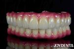 Lightweight Dental Titanium Malong Hybrid Bridge Comfortable For Dental