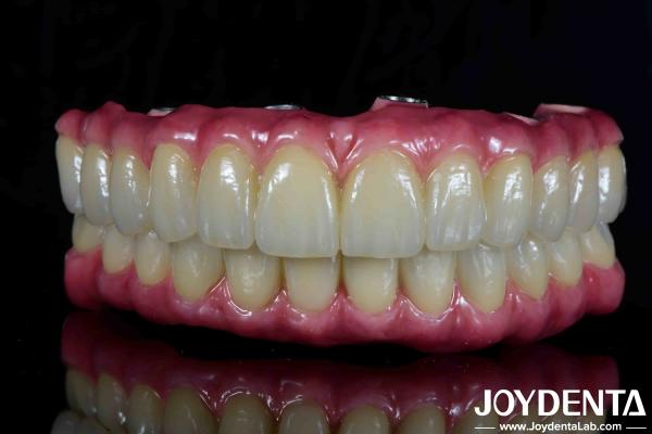 Lightweight Dental Titanium Malong Hybrid Bridge Comfortable For Dental