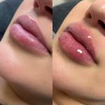 Ultra3 Ultra4 Voluma Hyaluronic Acid Dermal Filler Gel Juvederm Lip Filler 24mg