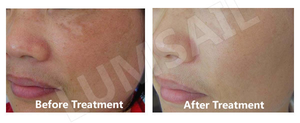 Air Cooling System LED Blue And Red Light Therapy Device For Elimination Fine Lines