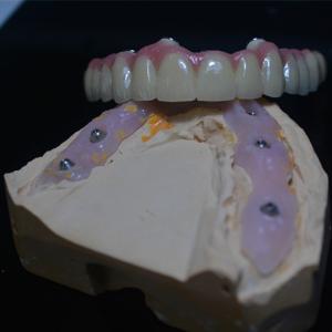 Wholesale The Perfect Fit Customization In Our Dental Implant Crowns from china suppliers