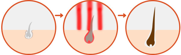 High End Laser Light Therapy For Hair Loss , Hair Growth Laser Treatment