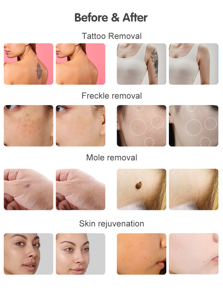 NIR Milk Light Whitening Hair Removal Machine Permanent Hair Remover Diode Laser 755 808 1064 Nm Diode Laser Hair Remover